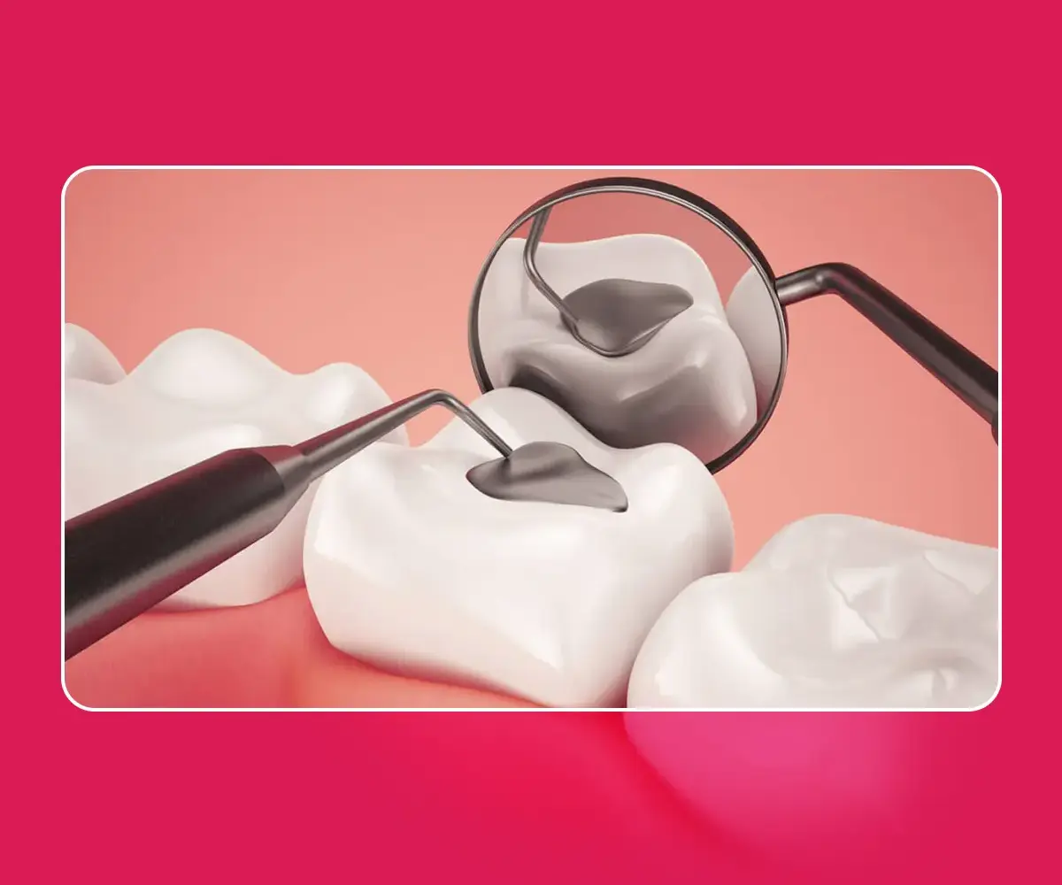 Dental Composite Fillings in Gurgaon
